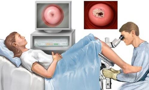 Cytologisk undersøgelse af livmoderhalskræft
