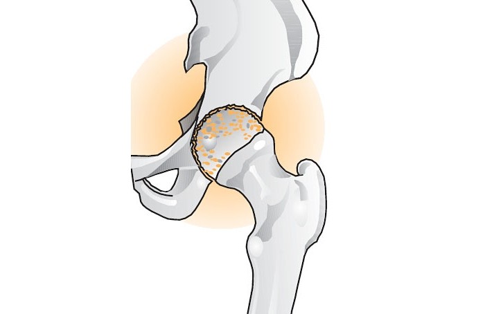 Hvordan man behandler coxarthrose med folkemægler?