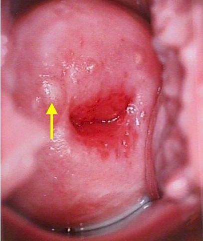 Hvad ser cervix ud før menstruationsperioden?