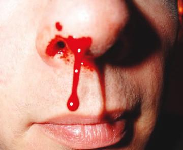 Hvordan man får blod fra næsen. De provokerende faktorer