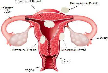 Er det muligt at blive gravid med en livmodermyom? Hvilke vanskeligheder kan der være?