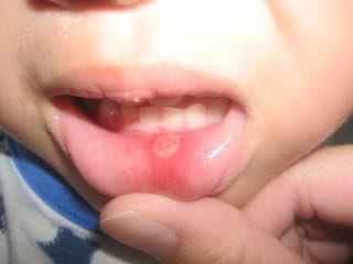 stomatitis fotobehandling