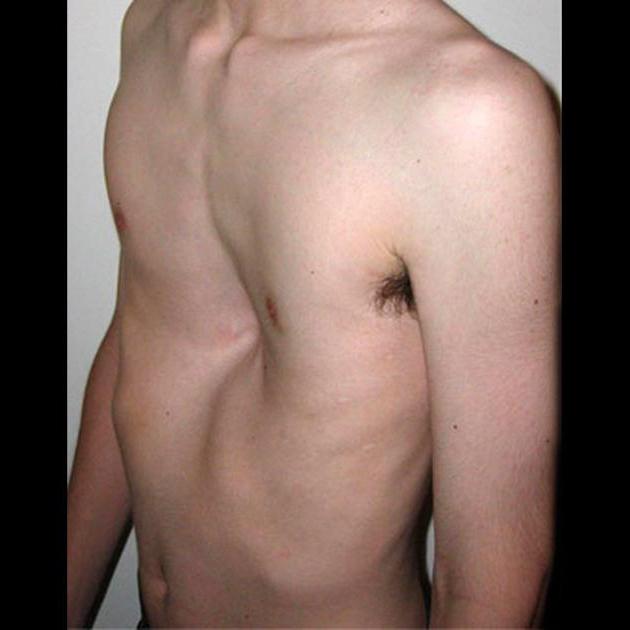 Trækformet deformation af brystet: Funktioner af forekomst og konsekvenser